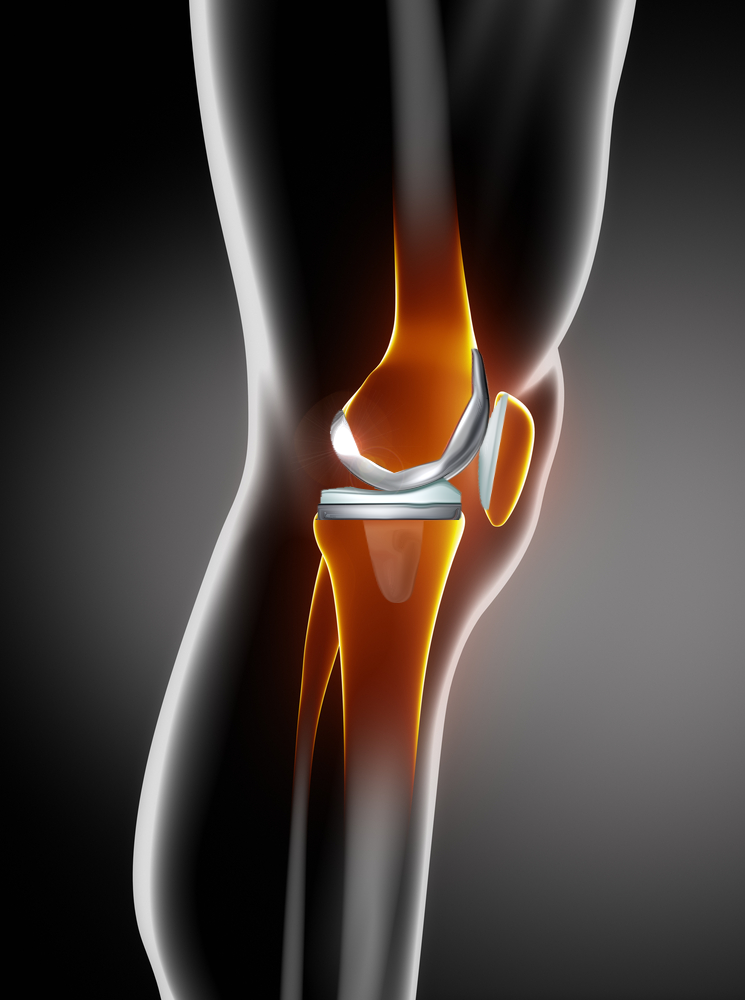 Outpatient Joint Replacement